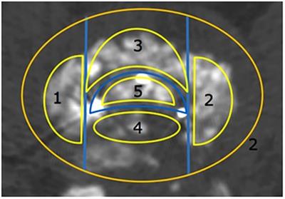 Characteristics of interbody bone graft fusion after transforaminal lumbar interbody fusion according to intervertebral space division